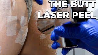 This butt laser peel corrects dark spots