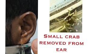 Crab inside ear / removed alive from ear