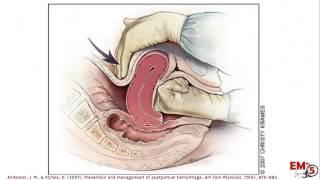 Postpartum Hemorrhage