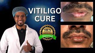 Vitiligo Treatment On Lips | No surgery, No tablets | Machu Clinic | Marathahalli Bangalore