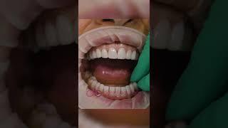 TOTAL MOUTH RESTORATION WITH PORCELAIN VENEERS  #Shorts