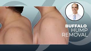 Buffalo Hump Removal: How To Rid Yourself of the Ugly Neck Hump