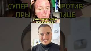 Супер рецепт против прыщей #прыщи #полезныесоветы #исмаилгусейнли