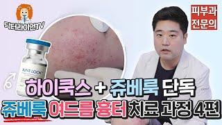 닥터라이언이 직접 보여주는 쥬베룩 여드름 흉터 치료 과정 4편 (하이쿡스 + 쥬베룩 단독)
