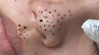 Big Cystic Acne Blackheads Extraction Blackheads & Milia, Whiteheads Removal Pimple Popping # 4677