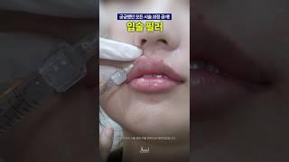 입술 필러 시술과정 대공개