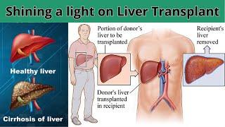 Shining a Light on Liver Transplant | Dania Medicare Solutions