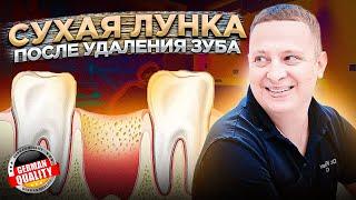 Сухая лунка - синдром после удаления зуба мудрости