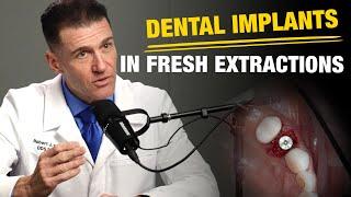 How to Place Implants into Fresh Extraction Sites