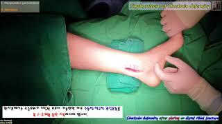 313.(환자/의사용.Surgery) Simple release of Checkrein in Distal lower leg.  장무지 굴곡근 구축 종아리 유리술 [강찬.충남대]