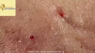 BIG Blackheads Removal   Acne Treatment   SPA ASMG   Blackheads Выдавливание черных точек