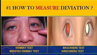 Measuring squint |  Krimsky and Modified KrimskyTest | Bruckners test