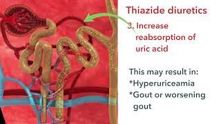 Thiazide diuretics: Hydrochlorothiazide, bendroflumethiazide and metolazone