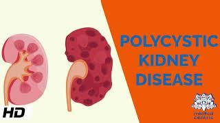 Polycystic kidney Disease, Causes, Signs and Symptoms, Diagnosis and Treatment.