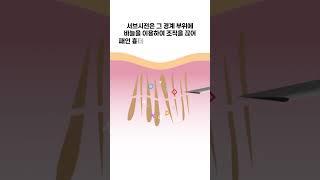 패인흉터, 여드름흉터 치료엔 #서브시전  #부산성형외과