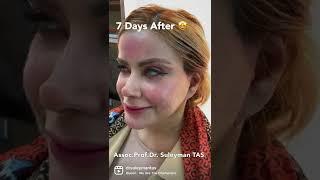 Face Lift Turkey | Mom To Daughter