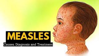 Measles, Causes, Signs and Symptoms, Diagnosis and Treatment.