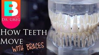 [BRACES EXPLAINED] How Teeth Move / Braces Work