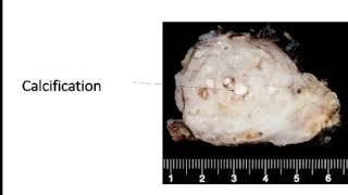 Gross and Microscopy of Reversible Injury by Dr. Dhara Mehta