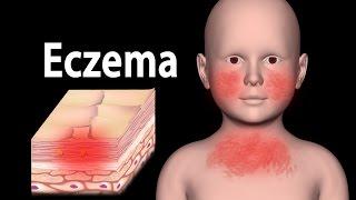 Eczema, Animation.