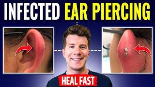 Doctor explains HOW TO RECOGNIZE AND TREAT INFECTED EAR PIERCING