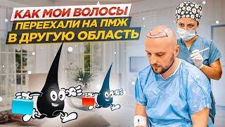 ПЕРЕСАДКА ВОЛОС на Северном Кипре КАКОВО ЭТО?! | Метод FUE личный опыт КИПРИОТИКИ