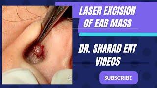 LASER EXCISION OF EAR MASS || Dr. Sharad ENT videos || #youtube #youtubevideo #laser #lasersurgery