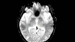 Cerebrovascular Disease Multiple embolic infarction, diffusion and FLAIR imaging