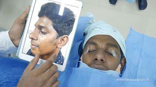 FACEMAKEOVER Surgery with Orthognathic, Jaw Osteotomies, Nosejob | Before After Results