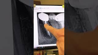 Proper diagnosis saves patient thousands of dollars. #endodontist #dentist #dentalprocedure #vrf