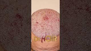 Dr.Hair: Clínica de Transplante Capilar FUE & DHI - Melhores Preços & Pacotes (Muriaé - MG)