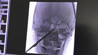 Boy miraculously survives 10-inch knife being lodged in his skull I ABC7