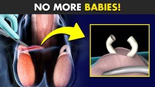 How Vasectomy Birth Control Surgery Is Performed? (3D Animation)