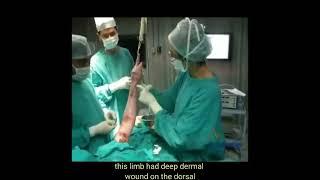 Burn Treatment collagen dressings colldrez for burns