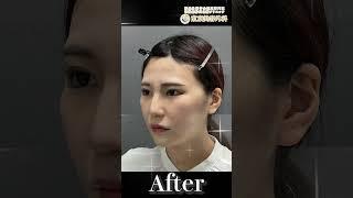 【小顔整形】美人すぎる整形後Before/after #整形 #お金持ちの息子の親父 #麻生泰 #東京美容外科 #Shorts