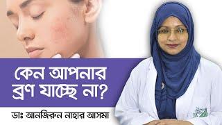 ব্রণ যাচ্ছে না কেন? - Pimple scars treatment - Scar on face treatment - ব্রণের দাগ