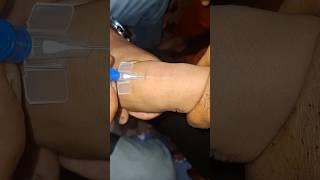 iv cannulation motivation #cannulainsertion #hospital #cannula #medicalprocedure