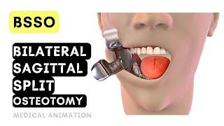 Bilateral Sagittal Split Osteotomy !? #surgical #video