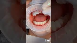 zarconium|teeth|implant|bracis|denture|smile lab