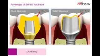 Osstem SmartFit Abutment. Kompodent