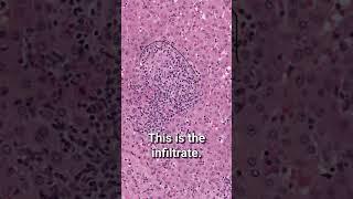 ANOTATING BIOPSIES: A Pathologist Perspective