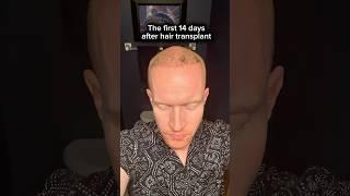 Hair Transplant Results: What Happens in the First 14 Days? (Shocking!)