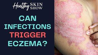 Eczema Triggered By HIDDEN Infections [CASE REPORT] | Jennifer Fugo