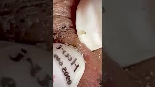 Skincare | Blackheads Removal #488 #tweezers skincare #blackheads blackheads