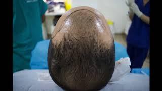 UK Hair Transplantation, The Treatment Rooms London