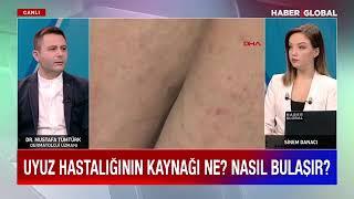 Uyuz Hastalığı nedir? Belirtileri nelerdir? Nasıl geçer? Dermatolog Dr. Mustafa Tümtürk @haberglobal