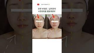  #안면비대칭 #한쪽입꼬리만올라간다 ⁉️ ️원인은 꼭있어요!! 그것을 함께찾아야 유지기간도 길어집니다 #윤곽관리 #증평