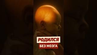 Как ЖИВУТ ЛЮДИ БЕЗ МОЗГА? #факты #интересно #медицина #аномалия #беременность #рождение #истории