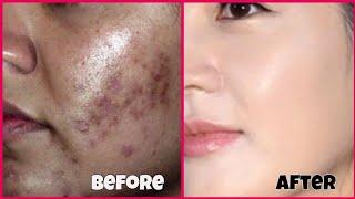 How To Cure High Pigmentation And Blemishes.By Sanam Ansari.