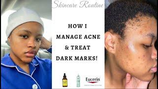 How I manage breakouts and treat dark marks //5-step Skincare Routine[South African YouTuber]